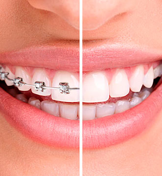 aparat dentar